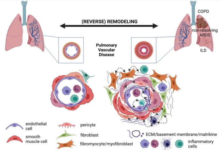 Aberrant Remodeling & Regeneration in Chronic Lung Disease - ILH Gießen